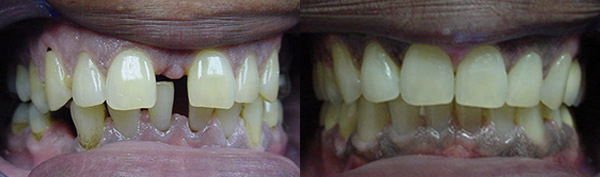 Spacing: Patient W.B. wore full braces and received implants for missing teeth